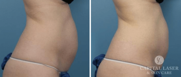 How Long Does It to See CoolSculpting® Results? MD | Chevy Chase CoolSculpting | Capital Laser & Skin Care