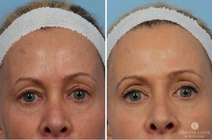 Ultherapy Chevy Chase