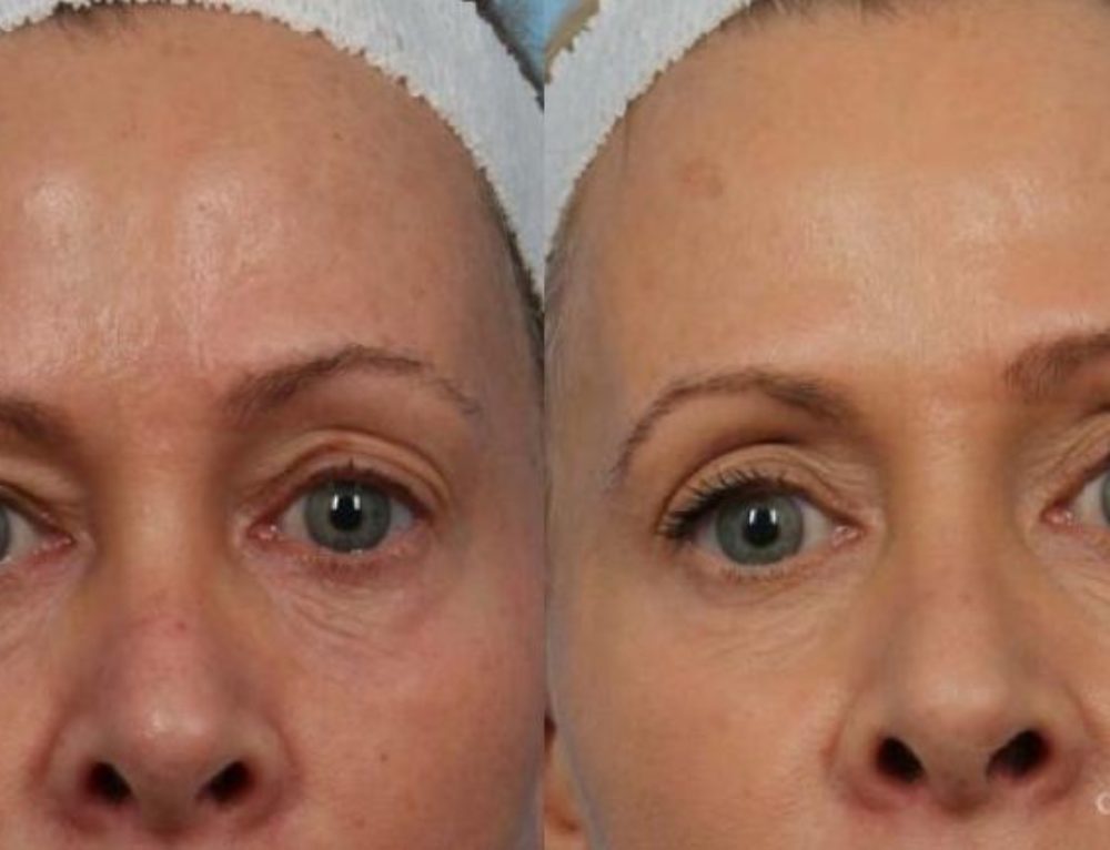 ultherapy typically tighten