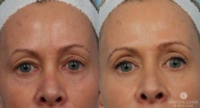 Ultherapy Chevy Chase