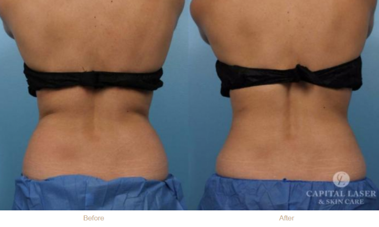 CoolSculpting - Flanks and Bra Strap Area Before & After Gallery