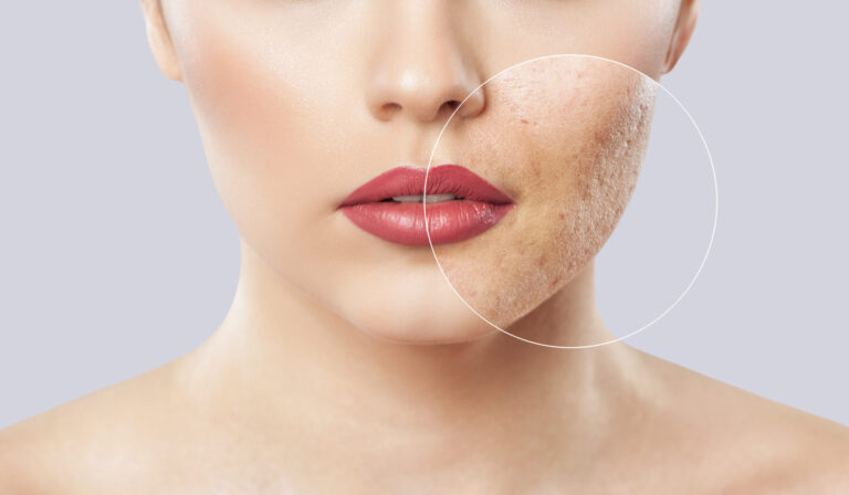 How Long Does It Take for Acne Scars to Fade?