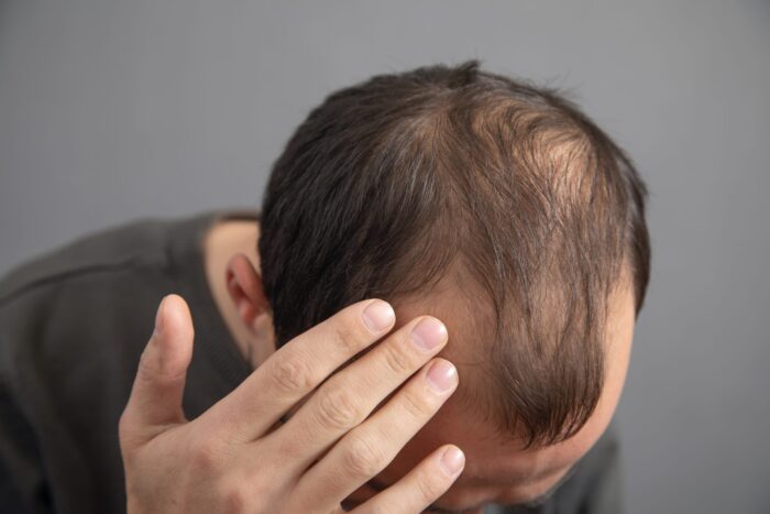 Hair Restoration Chevy Chase