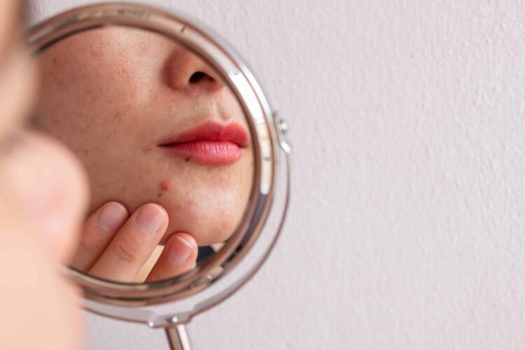 Acne Scars Chevy Chase & Washington DC