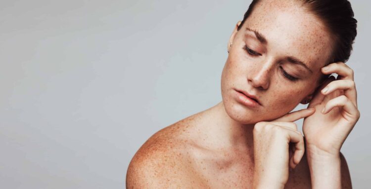 Halo™, BBL HERO™, Hyperpigmentation, Chevy Chase & Washington DC