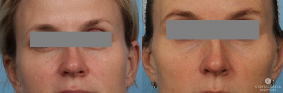 Dermal Fillers, RF Microneedling, Halo™, Chevy Chase & Washington DC