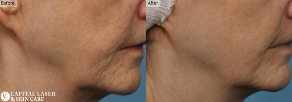 RF Microneedling, Chevy Chase & Washington DC